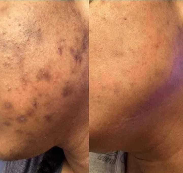 Sunburn face cream ( dark spot eraser ) 60 g