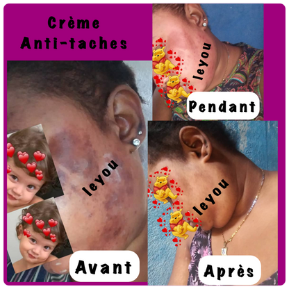 Sunburn face cream ( dark spot eraser ) 60 g